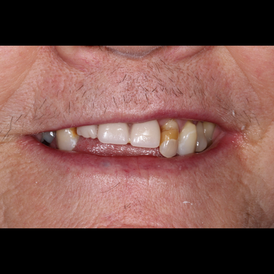 Dental Bridges - Smile 1 before